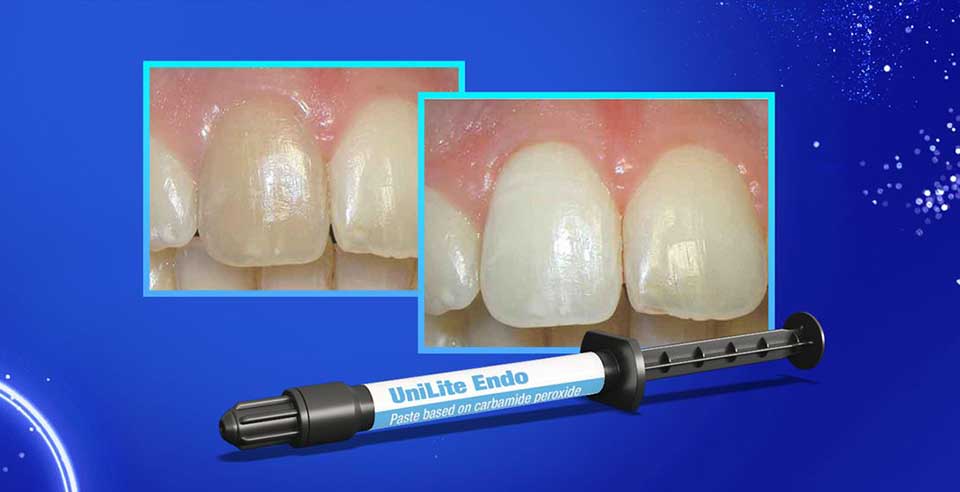 DSI Unilite Endo Whitening Paste- Bleaching of Non-vital Teeth