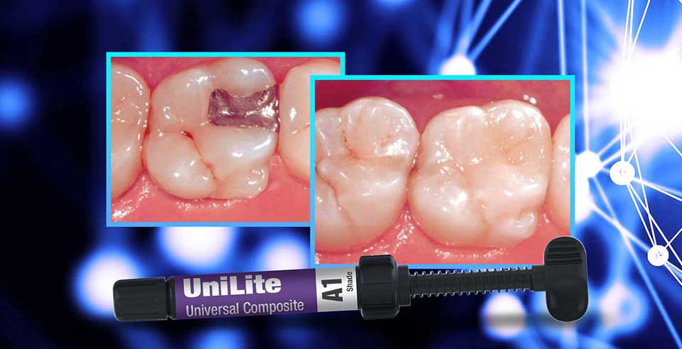 DSI UniLite-  Optimal Strength and Esthetics in Restorative Dentistry