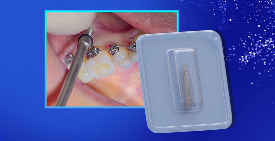 The Understanding of Temporary Anchorage Devices (TADs) in Dentistry