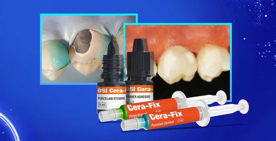 DSI Cera-Fix Repair Kit- Composite-to-Porcelain Dental Repair