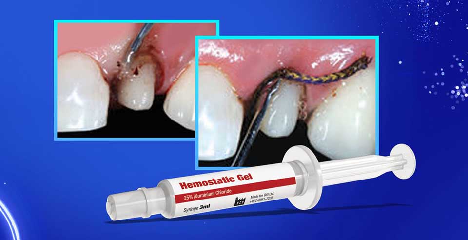 DSI Hemostatic Gel for Minor Cuts and Wounds on Teeth