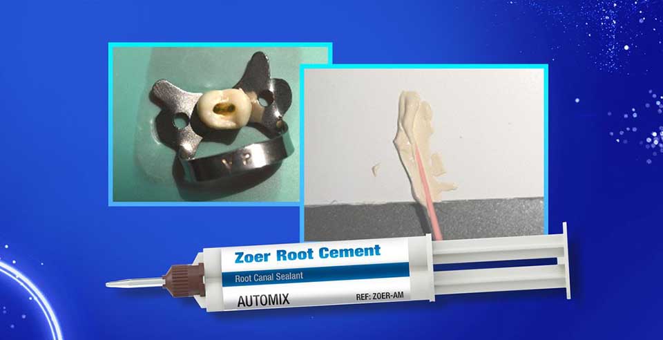 Zoer Root Canal Sealer- The Key to Quality Obturation