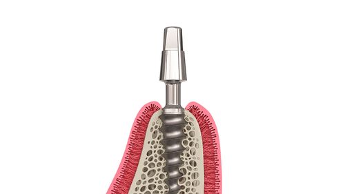 One-Piece Immediate MCB Implant