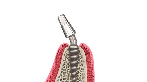 One-Piece Immediate MCB Implant