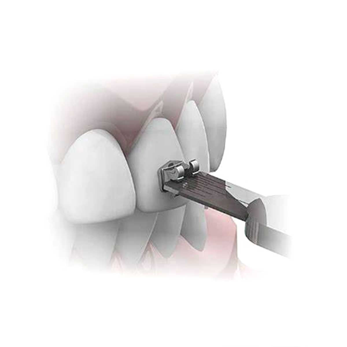 Morelli Orthodontic Tweezer With Aligner 144mm