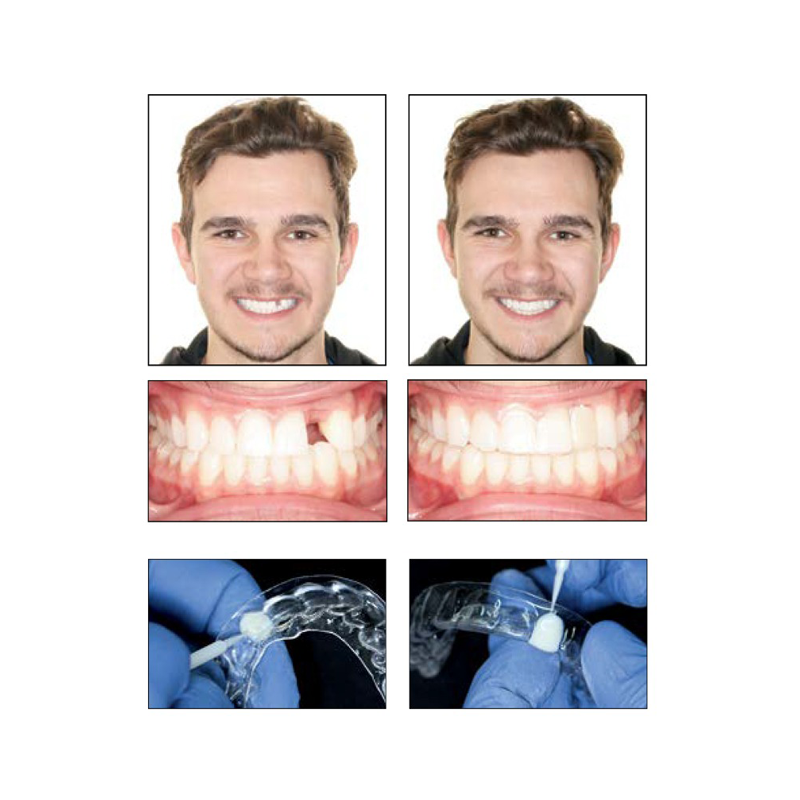 Perfect A Smile™ Pontic Paint by Reliance