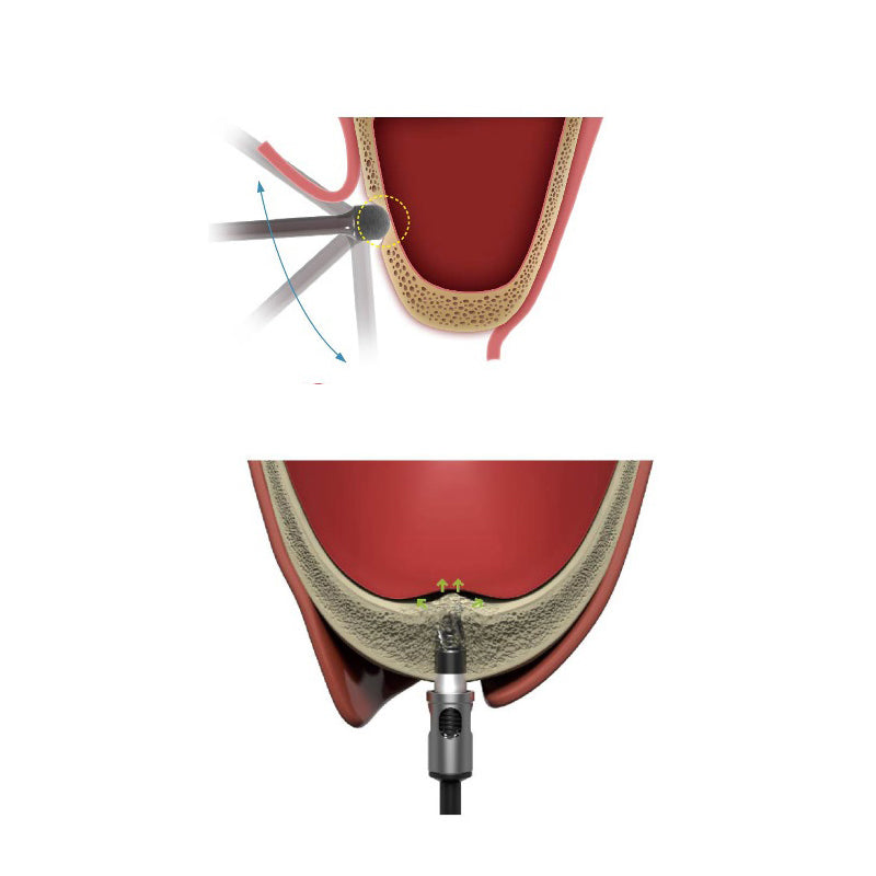 Dentium DASK Simple Sinus Kit