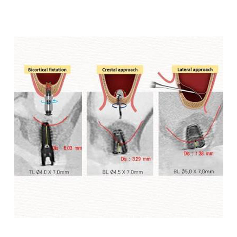Dentium DASK Simple Sinus Kit