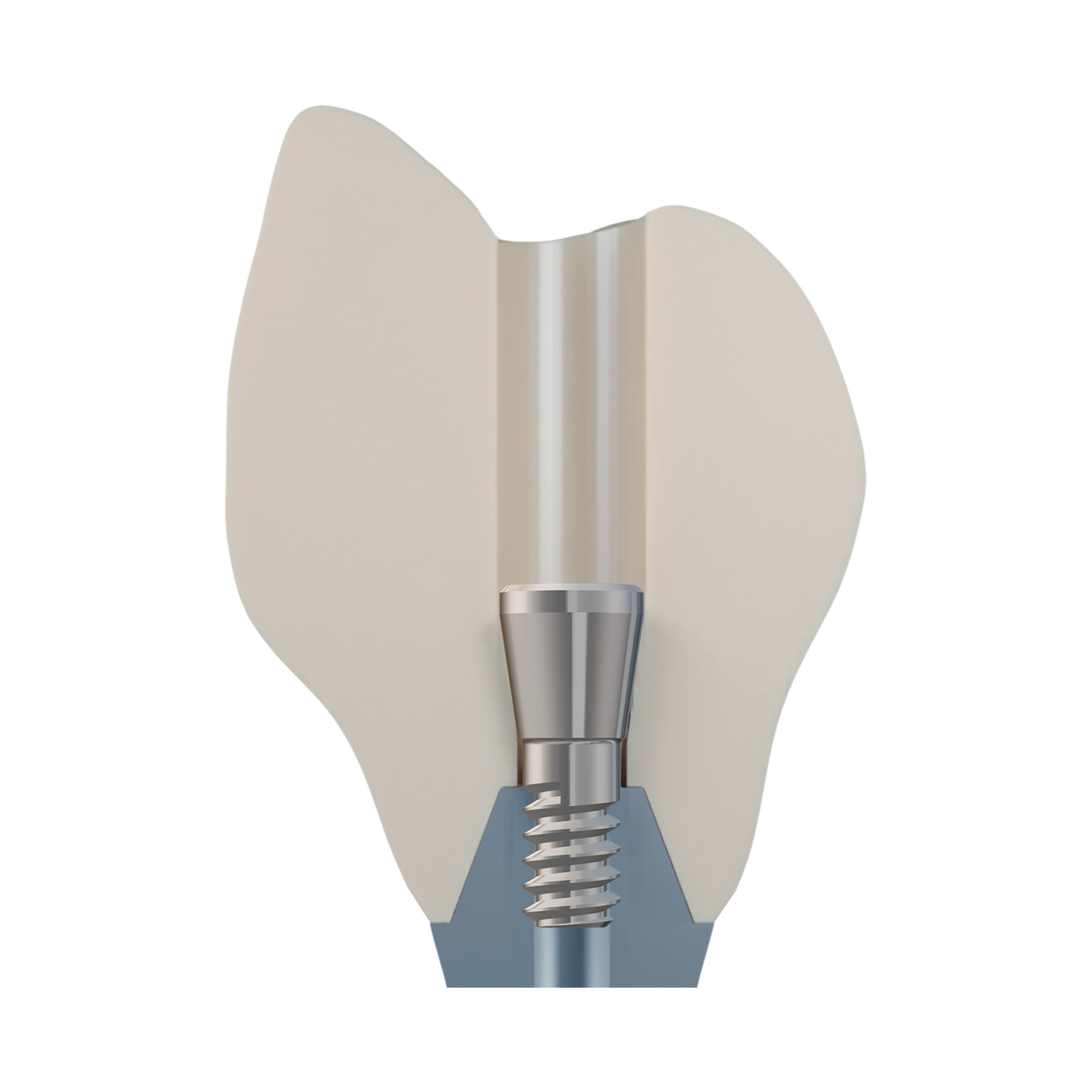 DSI EvoConnect - Direct Сonnection Screws for Multi-Unit Abutments M1.4
