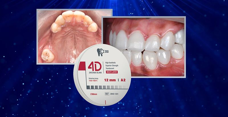 4D Zirconia - Beautiful and Natural, Layer-by-layer