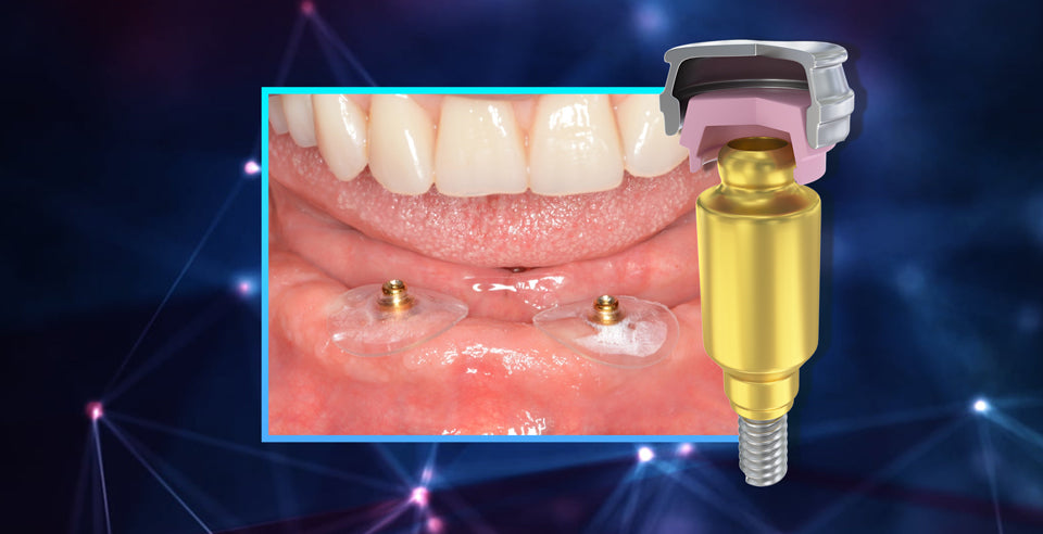 DSI Low-Lock- Innovative Solution for Overdenture Attachments