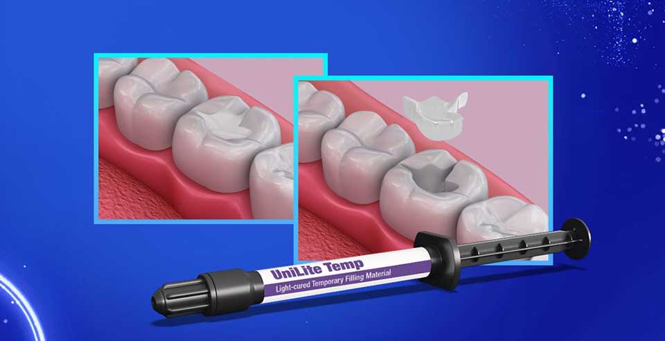 DSI UniLite Temp- Sealing Ability and Oral Fluid Resistance