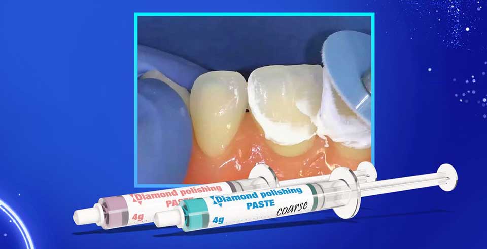 Polishing for Oral Health- DSI Diamond Polishing Paste