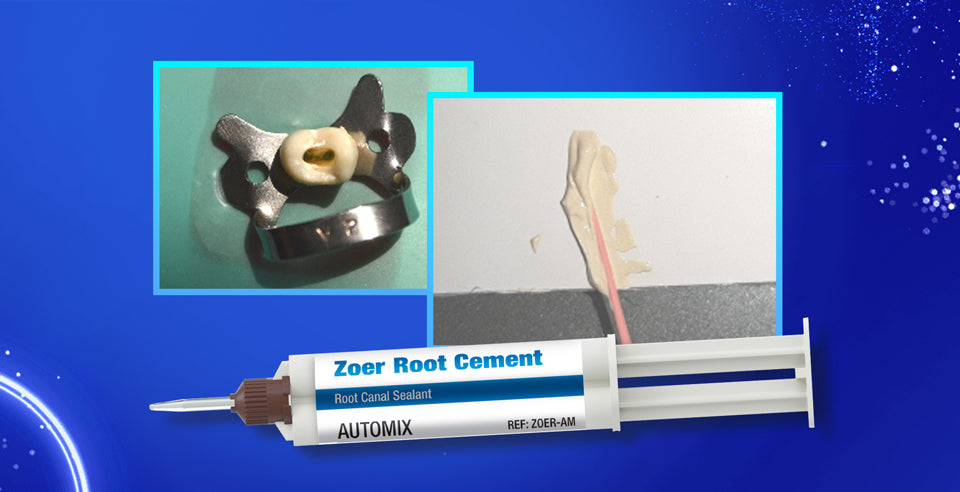 DSI Zoer Root Canal Sealer Efficiency for Dentists