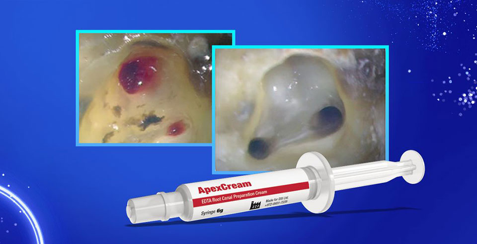DSI ApexCream- Smooth & Effective Root Canal Preparation