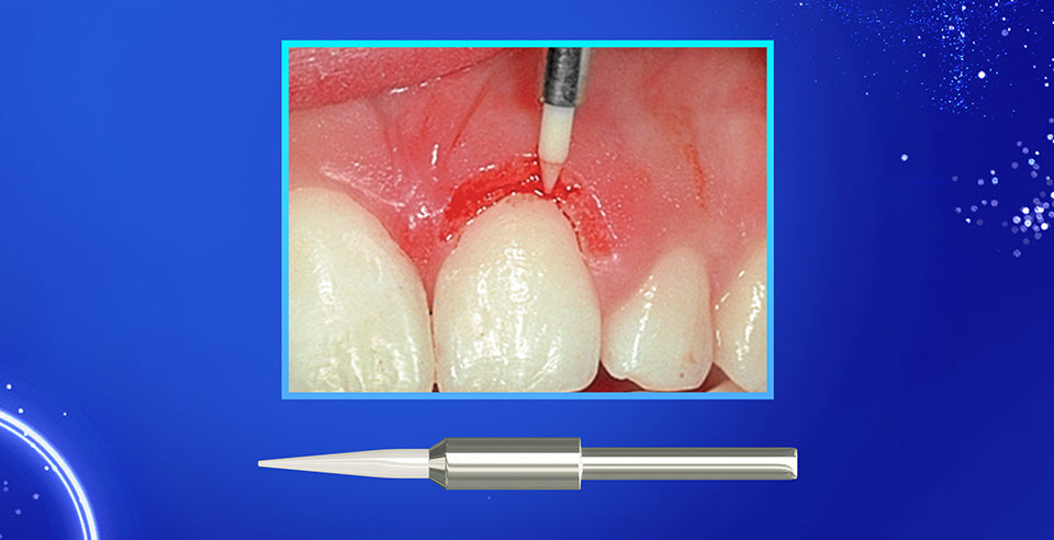 DSI STT Tissue Trimmer: A Tool for Gingival Trimming