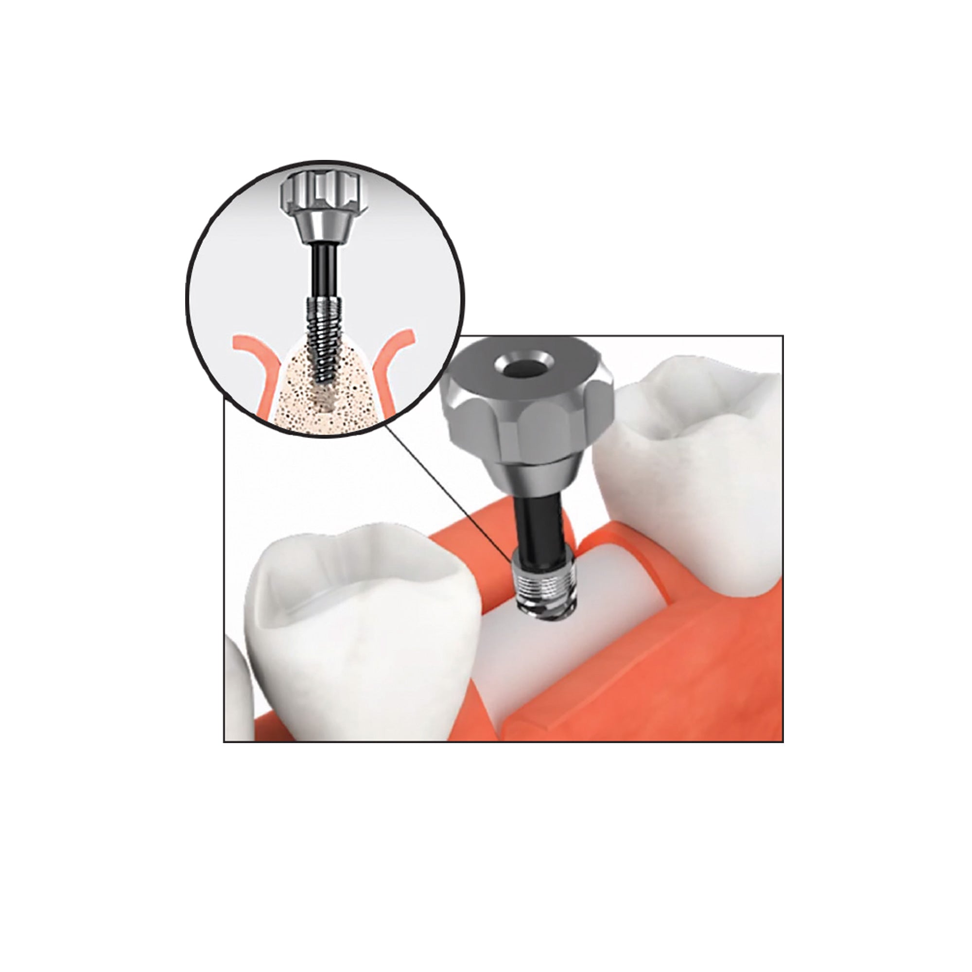 DSI DS-RKS Kit For Broken Implant Fixture & Screw Removal Extraction