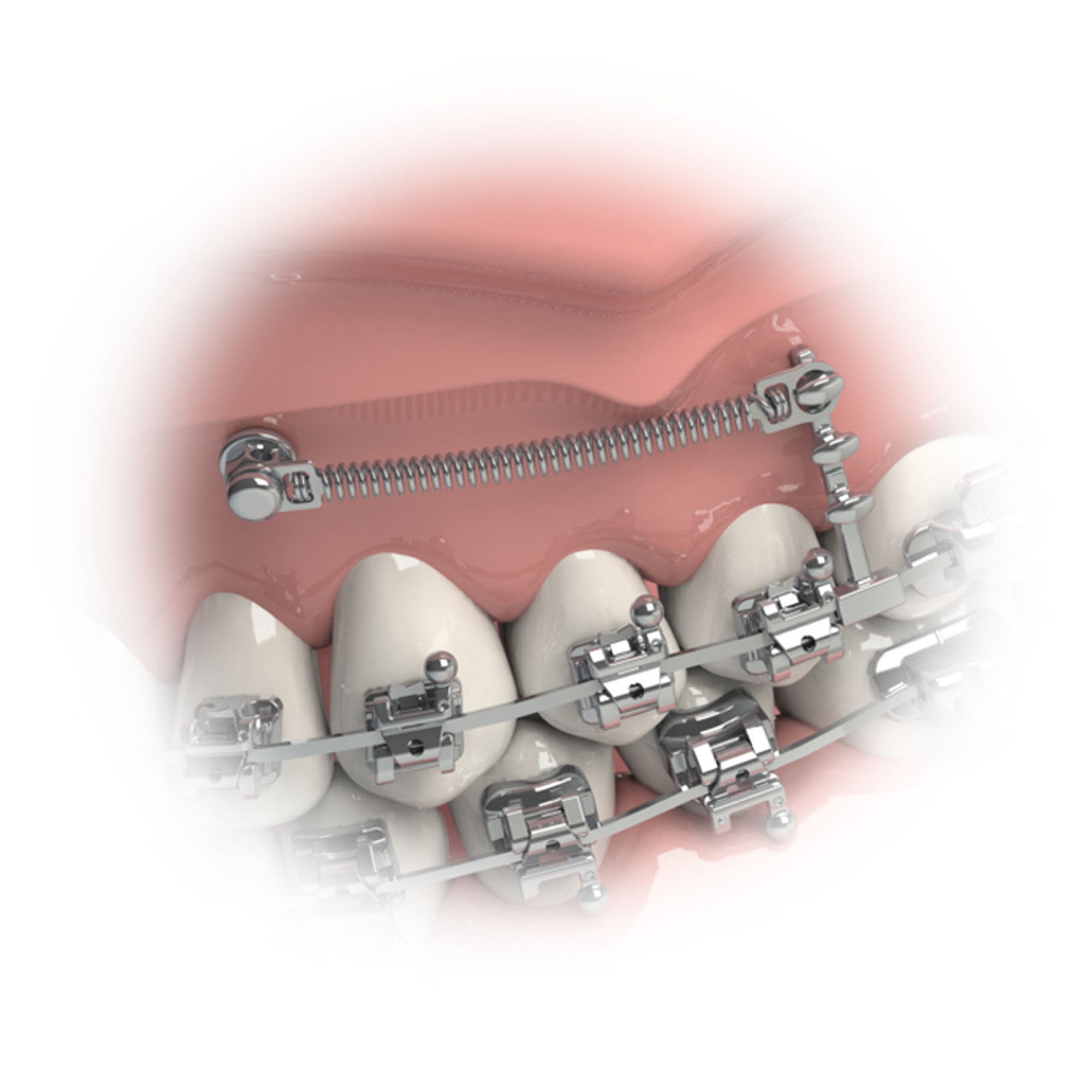 Morelli Orthodontic Universal Triple Hook For TAD Miniscrew