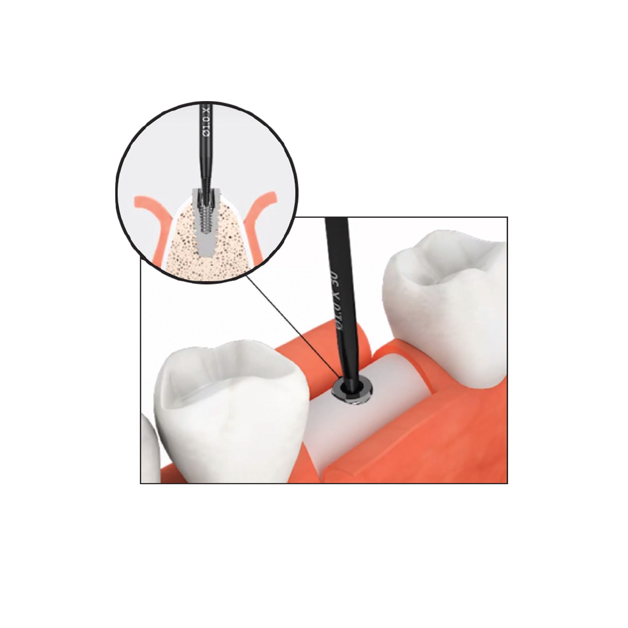 DSI DS-RKS Kit For Broken Implant Fixture & Screw Removal Extraction