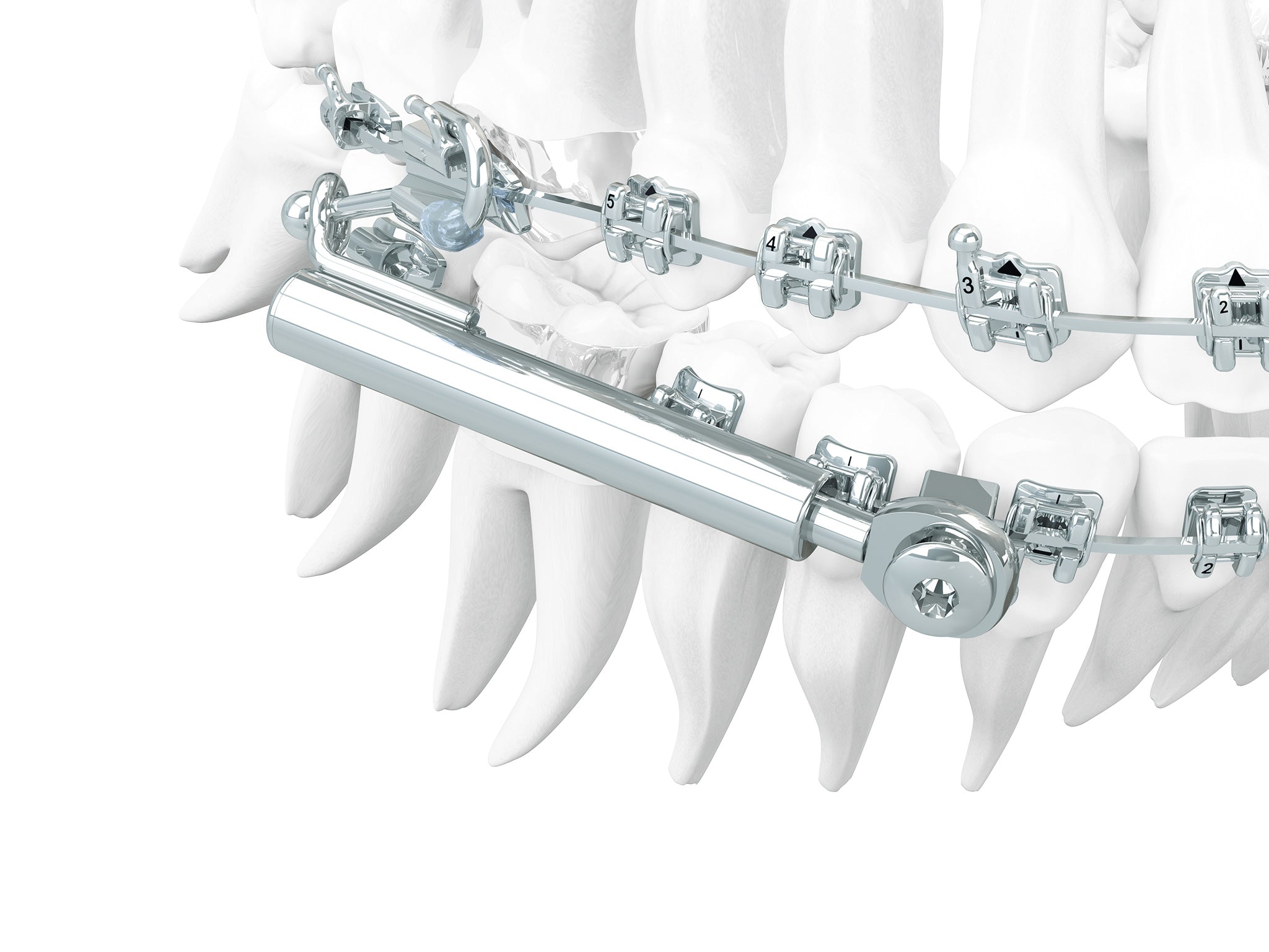 Dentaurum SUS3 Orthodontic Sabbagh Universal Spring Starter Set