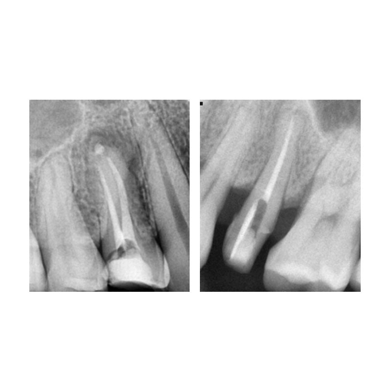 Any-Paste® Temporary Root Canal Filling Material 2g