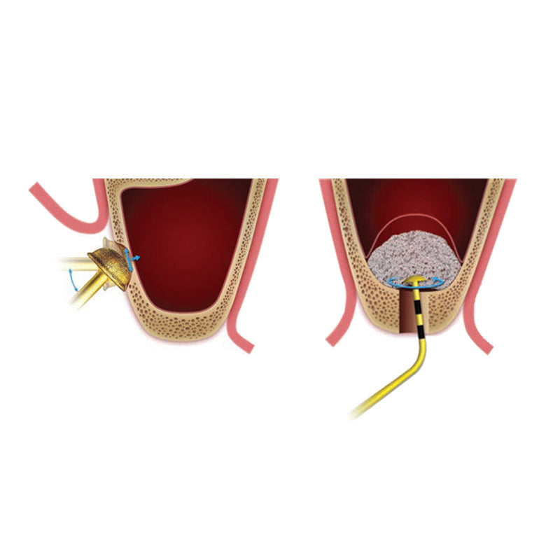 Dentium DASK Advanced Sinus Kit
