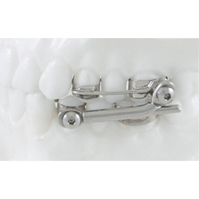 Advanced Kit for Herbst I System