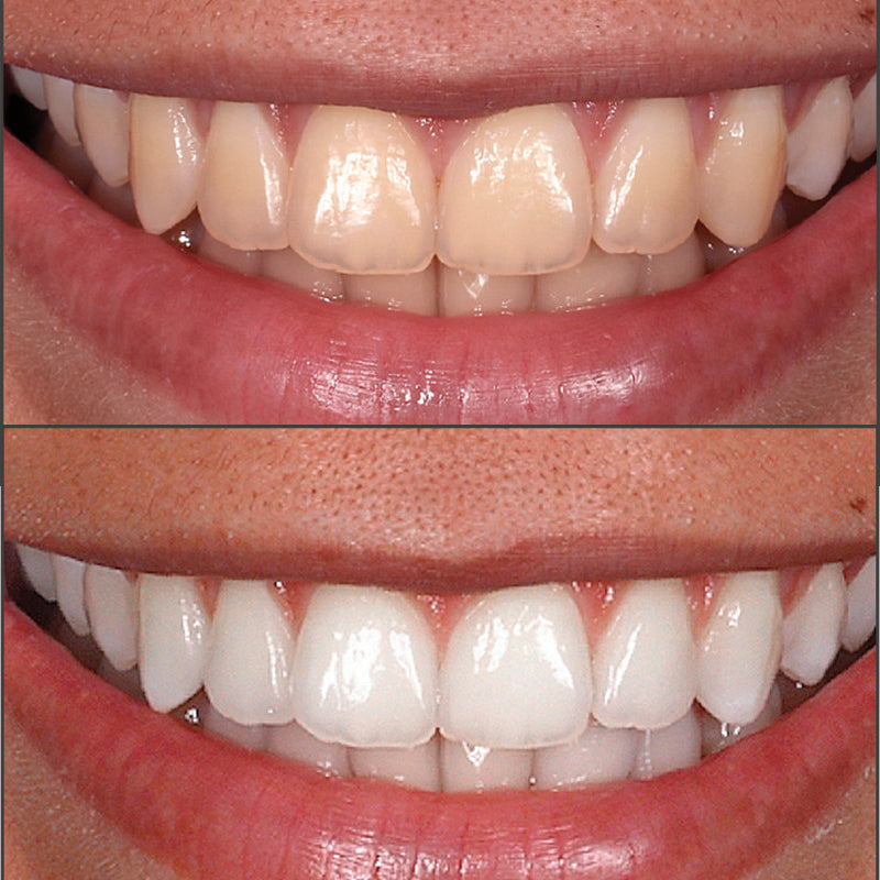 FGM Whiteness Perfect 10/16/22% syringe 3g