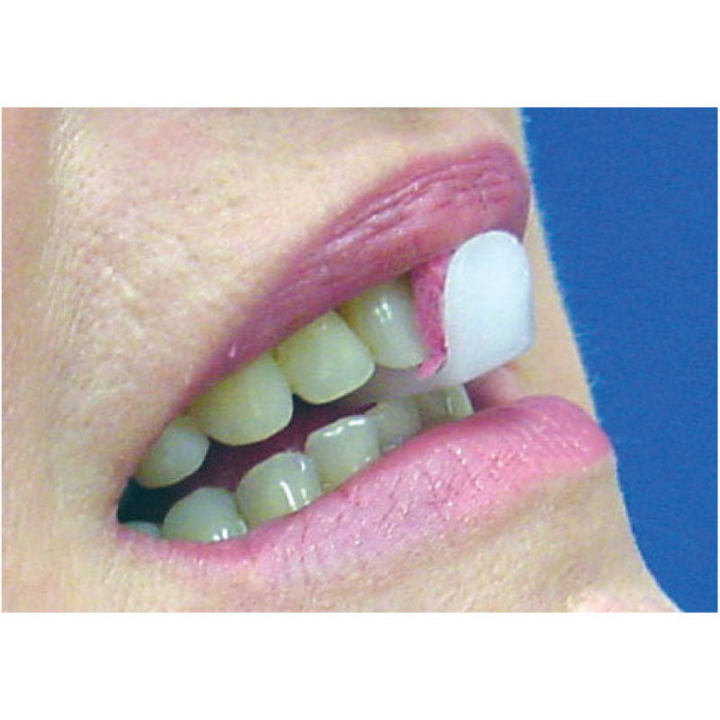 Lucia Jig Anterior Deprogrammer